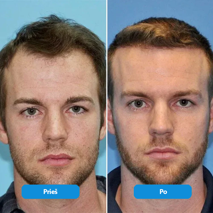 Plaukų augimą skatinantis serumas