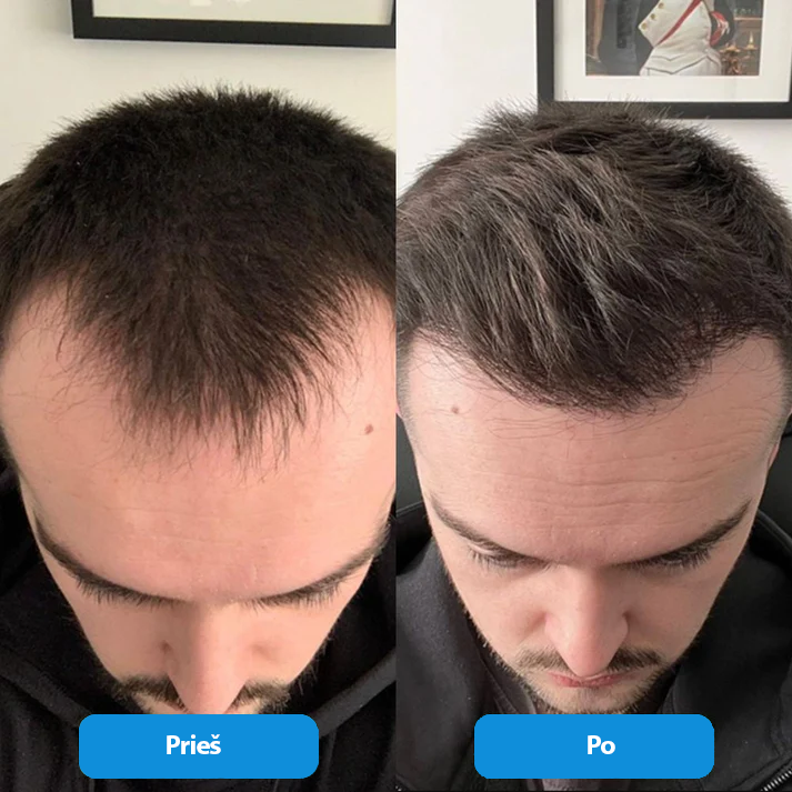 Plaukų augimą skatinantis serumas