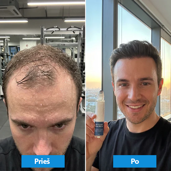 Plaukų augimą skatinantis serumas